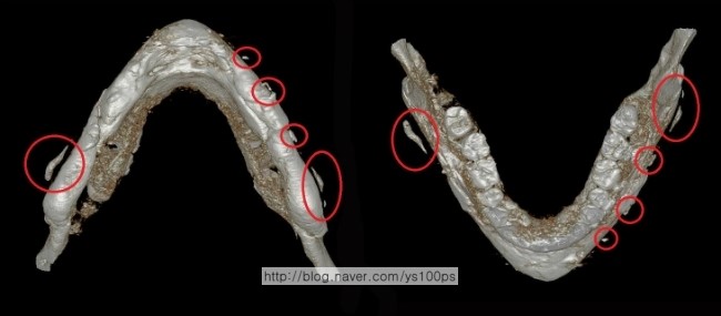 하악각 주변에 떨어져 남은 본시멘트 조각을 빨간 원으로 표시한 3D CT