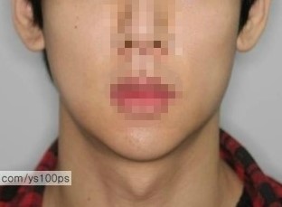 사각턱과 턱끝 재건수술 전후의 정면 얼굴 비교