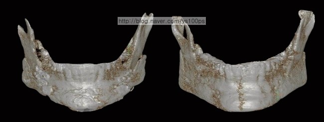 여러 본시멘트 조각으로 재건된 수술 전과 매끄럽게 재건된 수술 후 정면 3D CT