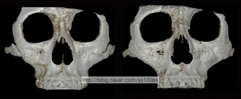 광대 결손 부위 재건 전후 정면 3D CT