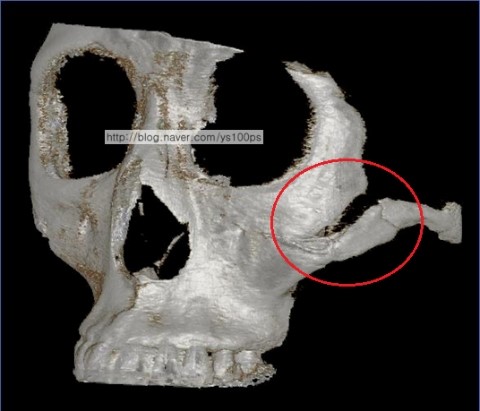 광대축소술 후 골편이 제거된 좌측 광대 체부 3D CT