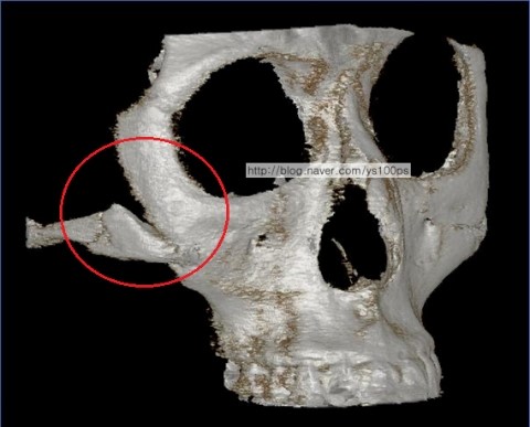 광대축소술 후 골편이 제거된 우측 광대 체부 3D CT