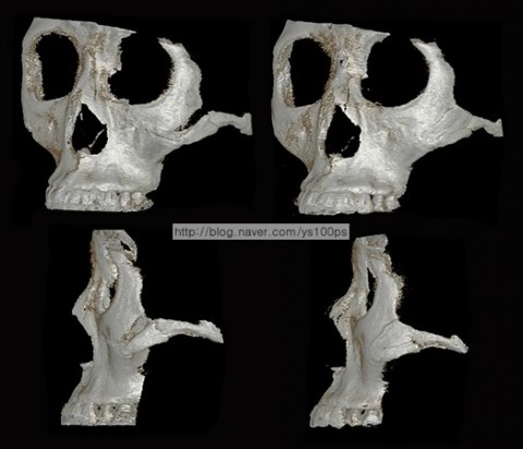 좌측 광대 결손을 3D Fit PMMA로 재건한 3D CT