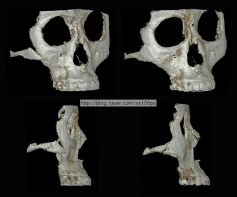 우측 광대 결손을 3D Fit PMMA로 재건한 3D CT