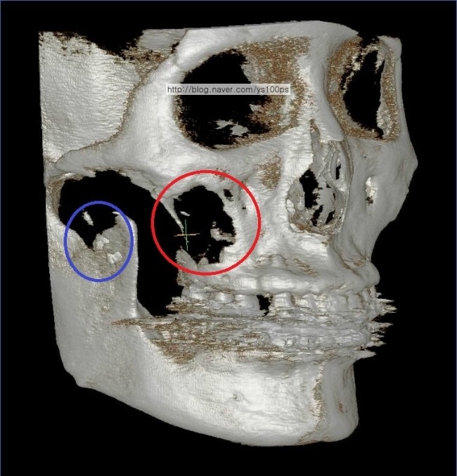 우측 광대와 볼 함몰의 원인이 된 골 결손 3D CT