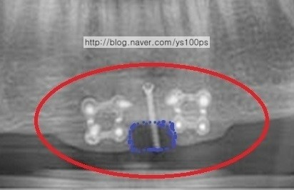 턱끝 골편 사이 메드포어 위치와 이차각을 표시한 3D CT