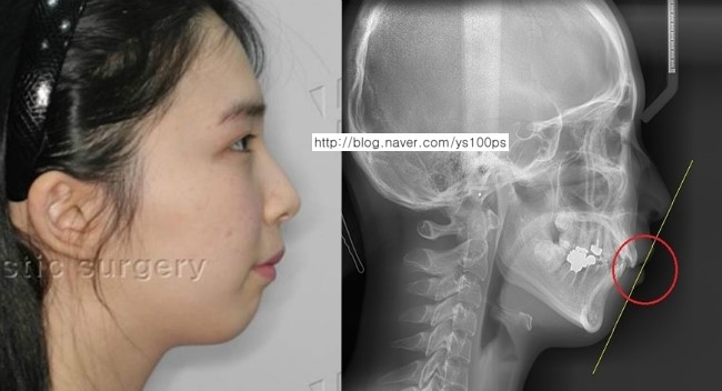 무턱과 입술 돌출 인상을 분석한 수술 전 측면 사진