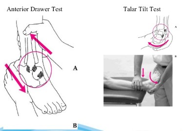 Ankle Sprain 네이버 블로그