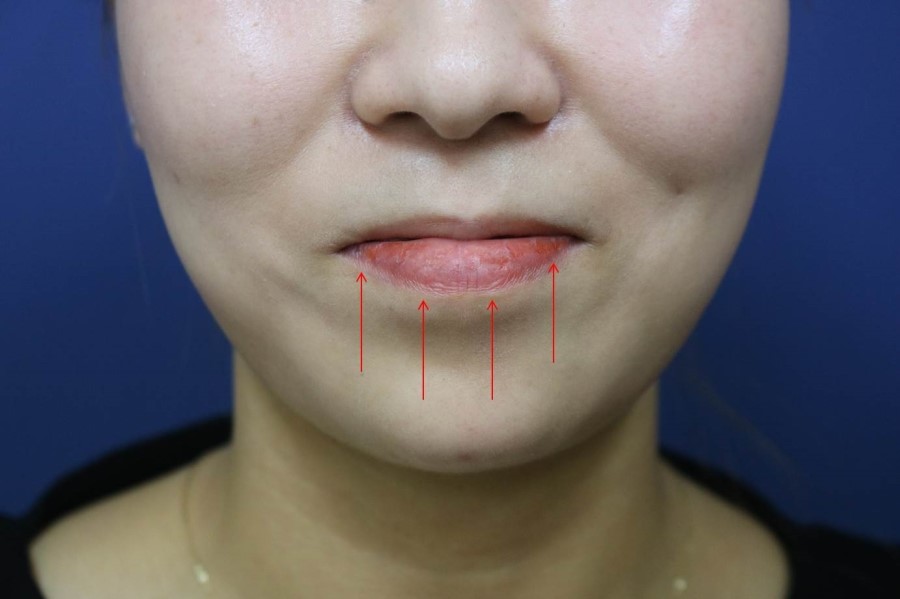 자갈턱보톡스(호두턱 또는 턱끝 보톡스) 효과와 부작용 : 네이버 블로그