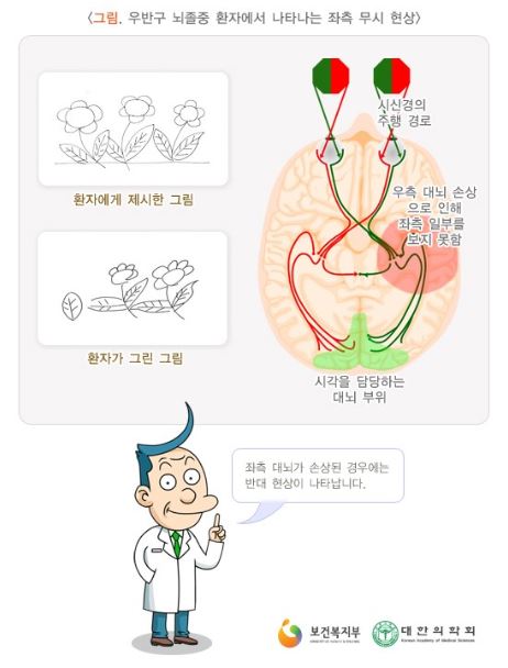 편측무시 (Unilateral neglect) : 예성요양병원 재활/작업 치료 [제천병원/단양병원/영월병원/충주병원/영주병원 ...