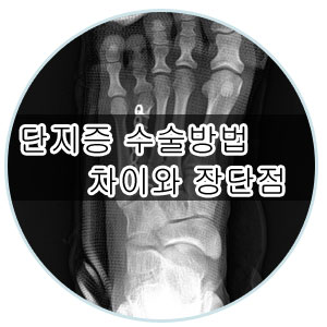 [부산 성가병원] 단지증 수술 방법의 차이와 장단점에 대해 설명드리겠습니다. : 네이버 블로그