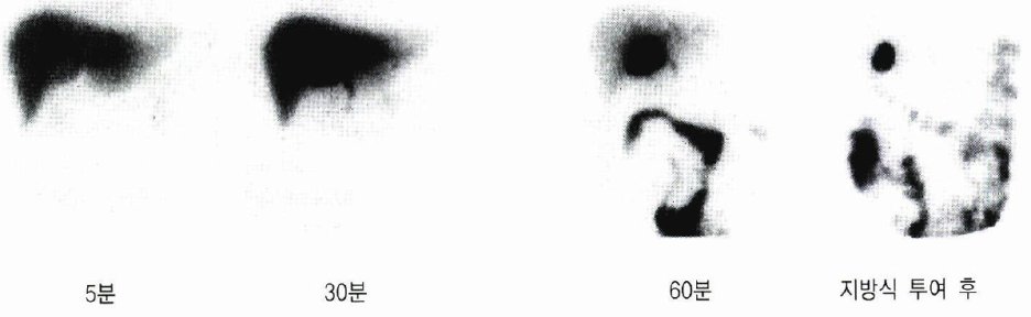 간담도 정밀검사 (간담도 스캔, Hepatobiliary scan, DISIDA) : 네이버 블로그