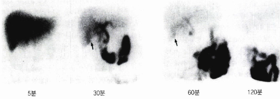 간담도 정밀검사 (간담도 스캔, Hepatobiliary scan, DISIDA) : 네이버 블로그