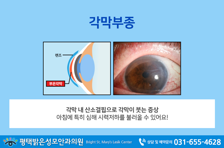 렌즈 오래끼면 안되는이유 각막부종 : 네이버 블로그