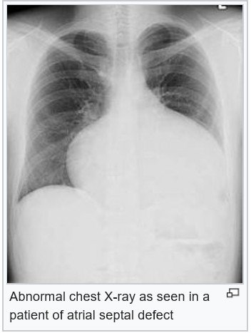 atrial septal defect(ASD, 심방중격결손) : 네이버 블로그