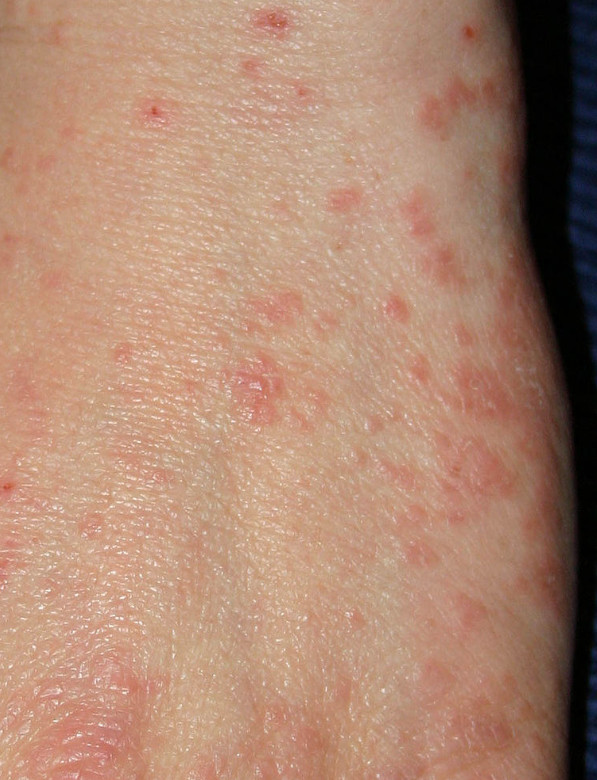 Scabies 옴 네이버 블로그