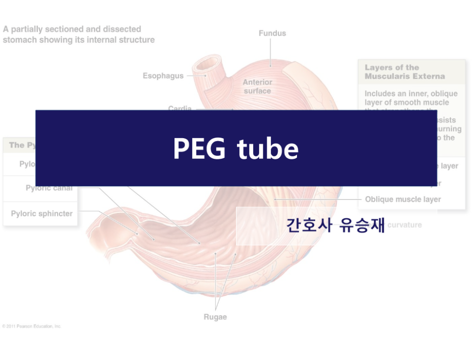 경피적 내시경 위조루술 (PEG tube) 네이버 블로그