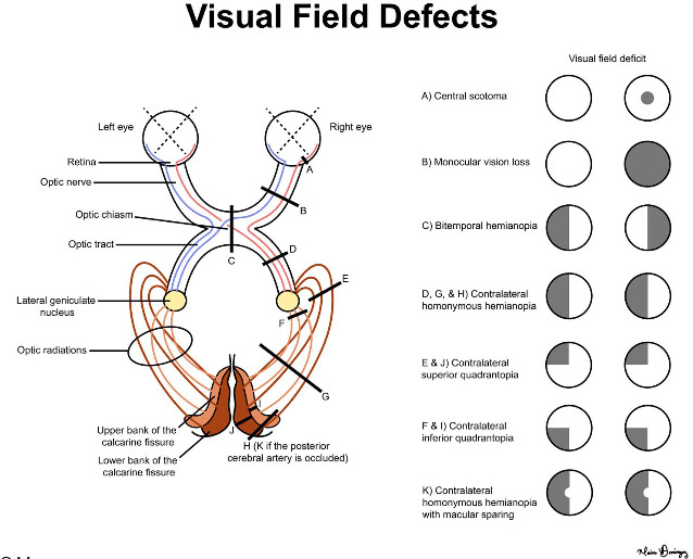 brain lesion and visual field defect 네이버 블로그