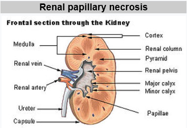 renal papillary necrosis (acute papillary necrosis) : 네이버 블로그