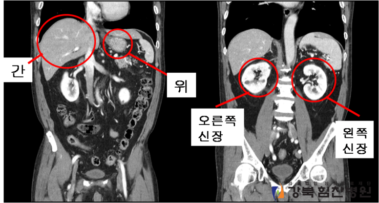 CT영상을 통해 인체 복부 구조를 알아보아요 : 네이버 블로그