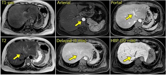 간(liver) MRI 프로토콜 : 네이버 블로그