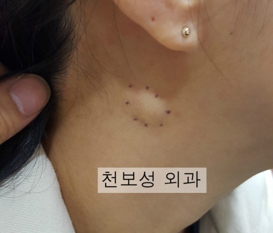다산 목과 사타구니에 피지낭종 핀홀법 재발 수술 (강동중앙 내과외과 천보성) : 네이버 블로그