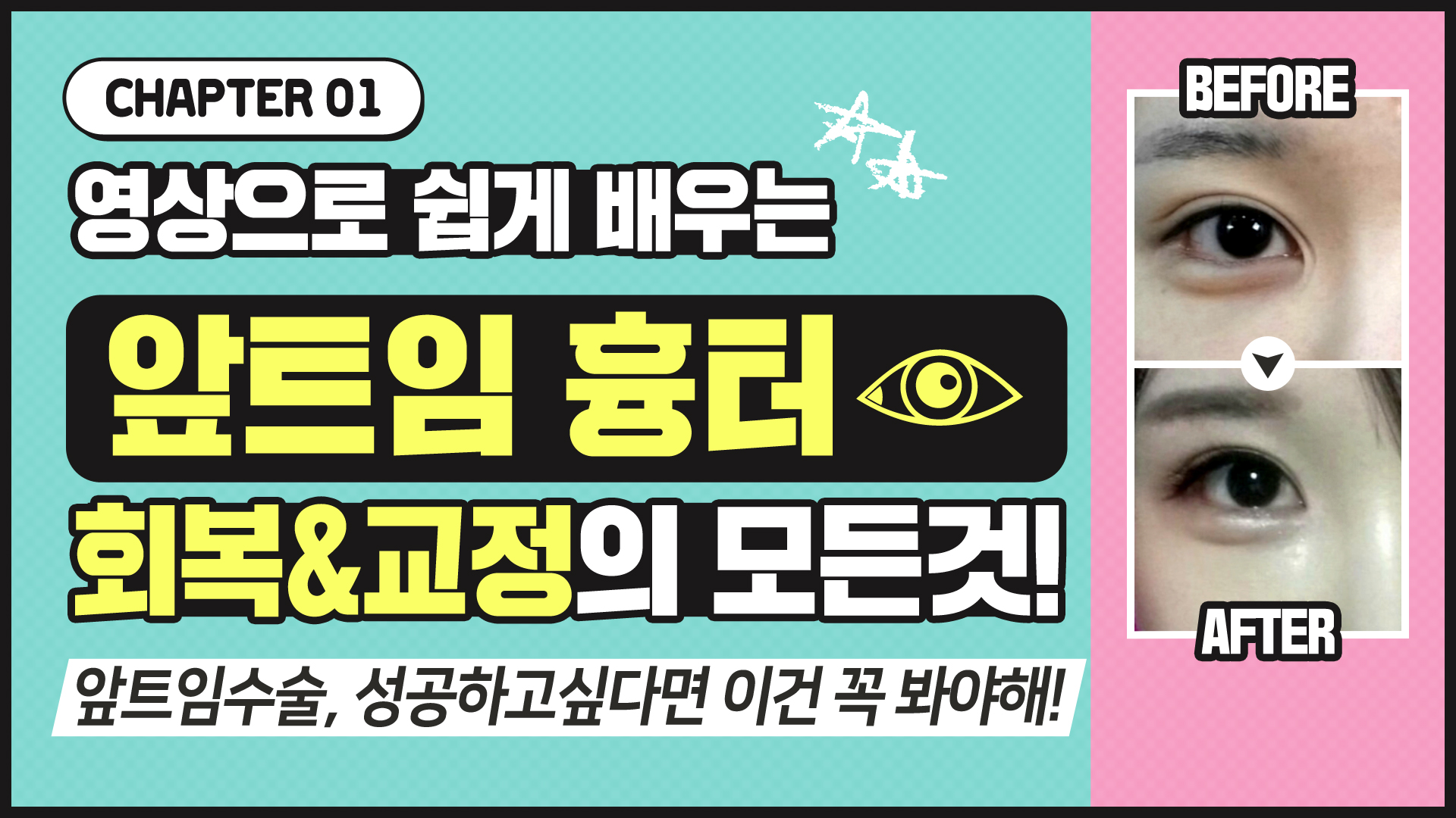 Part.#1 앞트임흉터복원, 영상으로 배우는 회복교정!