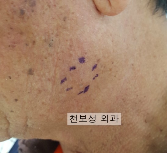 얼굴에 피지낭종 핀홀법 제거 (강동중앙 내과외과 천보성) : 네이버 블로그