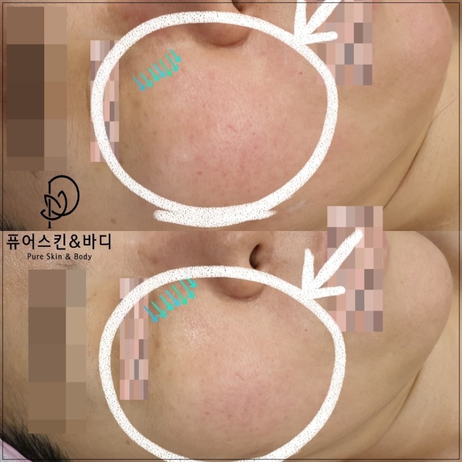 퓨어스킨 이미지