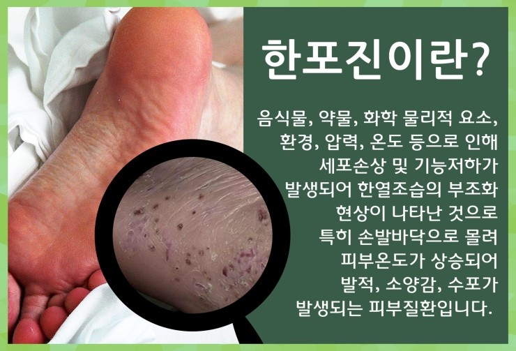 발바닥 수포 지겨운 증상들 때문에 : 네이버 블로그 발바닥 수포 지겨운 증상들 때문에 : 네이버 블로그