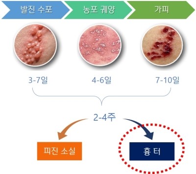 [청주 대상포진] 피부증상의 경과 : 네이버 블로그