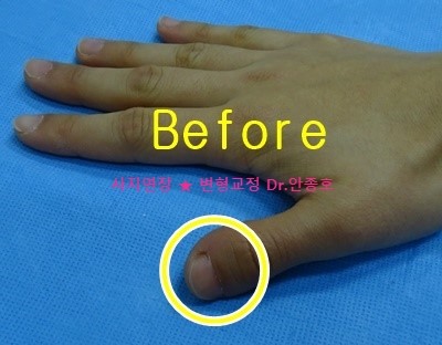 단지증 손가락 타입 D 수술후 회복과정 : 네이버 블로그