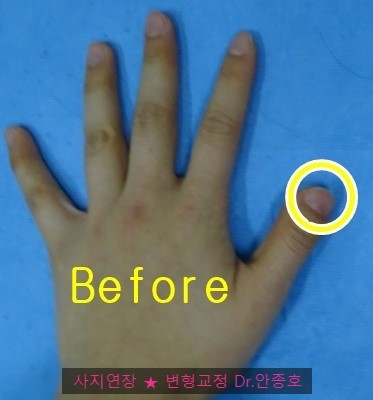 우렁손톱 수술전후기 : 네이버 블로그