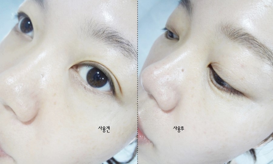 바른선 테라피 이미지