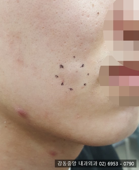 얼굴에 피지낭종 핀홀법 수술 흉터 걱정 NO!!!! (천보성 외과) : 네이버 블로그 얼굴에 피지낭종 핀홀법 수술 흉터 걱정 No!!!! (천보성 외과) : 네이버 블로그