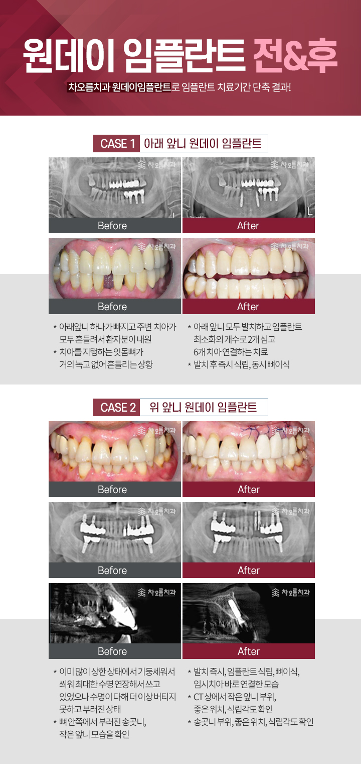 턱 임플란트 전후 3D 예상 - 해야 할까요? : r/jawsurgery, image size:720x1520