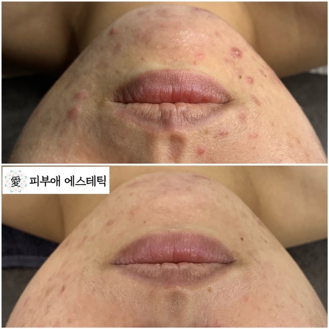 피부애 이미지