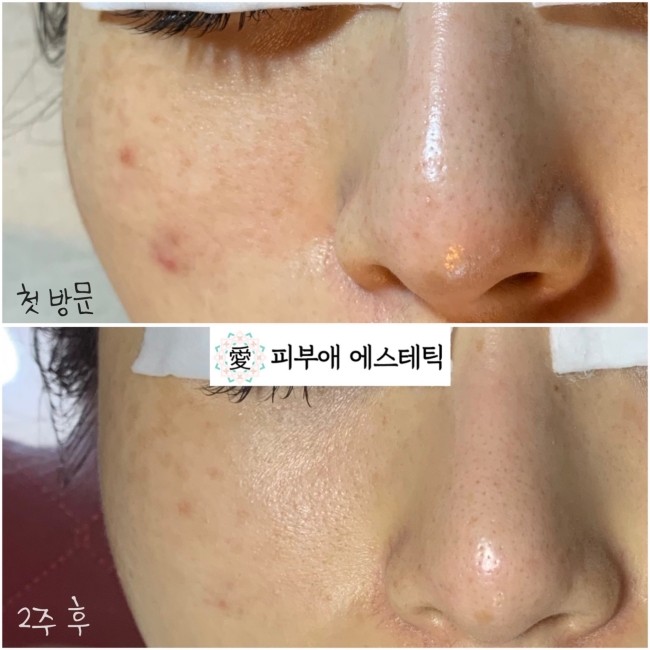 피부애 이미지