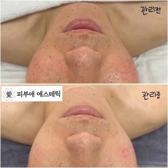 피부애 이미지