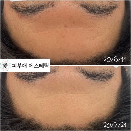 피부애 이미지