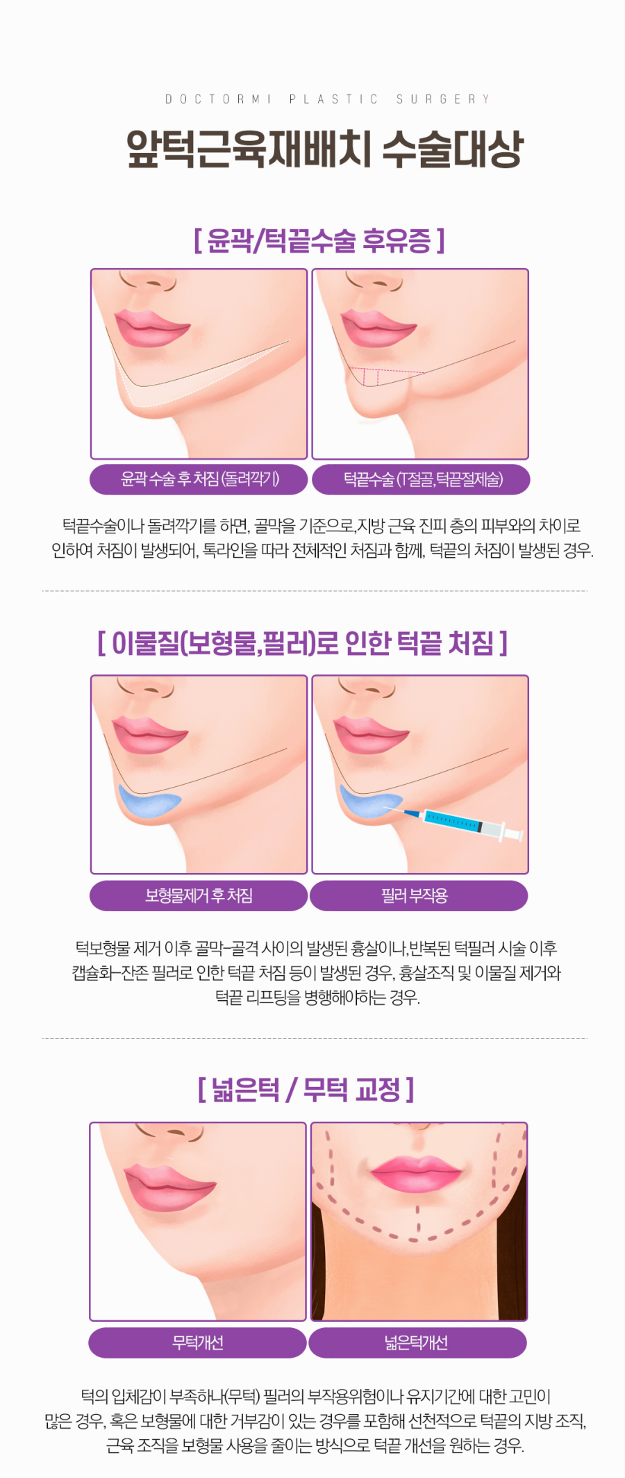마녀턱수술 비용 가격, 방식에 따라 달라져 : 네이버 블로그