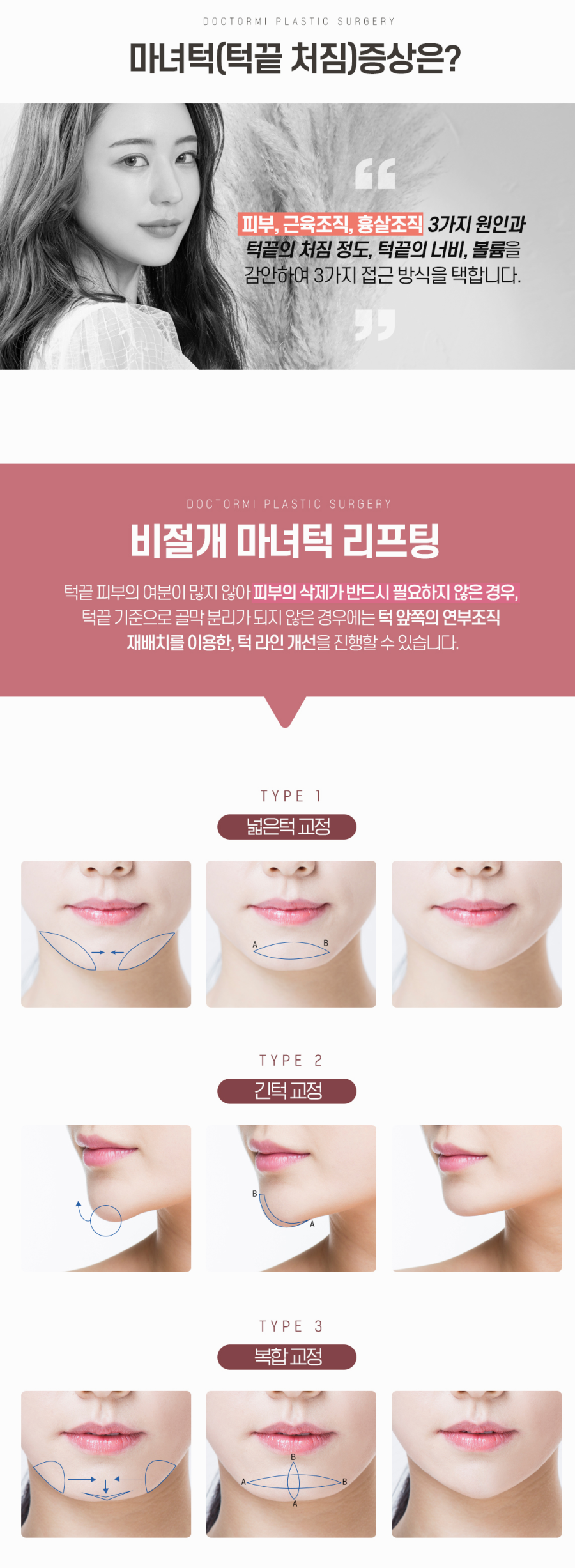 마녀턱수술 비용 가격, 방식에 따라 달라져 : 네이버 블로그