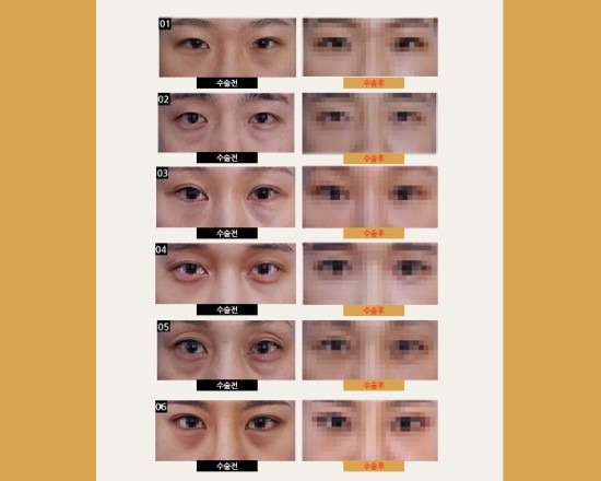 이노케이스 이미지