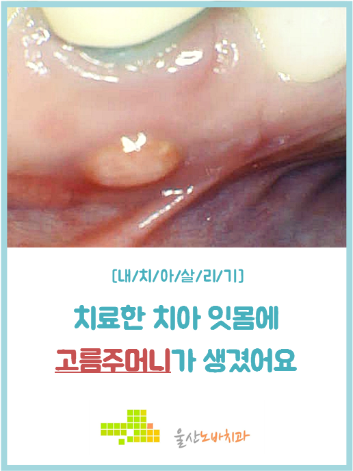 울산 삼산치과 노바치과 잇몸에 고름주머니 치료 내 치아 살리기 : 네이버 블로그 울산 삼산치과 노바치과 잇몸에 고름주머니 치료 내 치아 살리기 : 네이버 블로그
