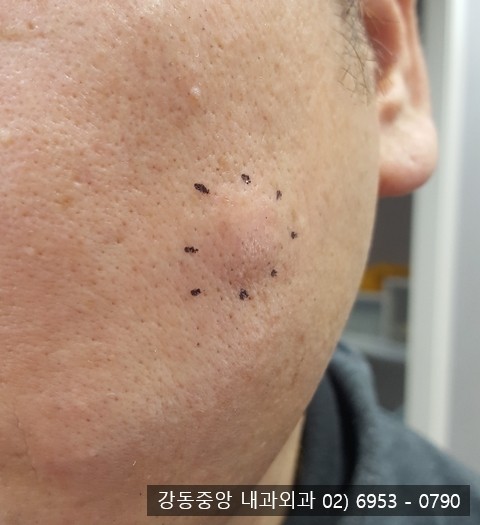 얼굴 핀홀법 피지낭종 수술 성형외과 Vs 외과 ? (천보성 외과) : 네이버 블로그