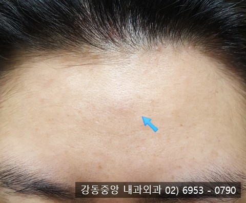 이마에 피지낭종 핀홀법 최소절개 수술 인천에서 왔어요 (천보성 외과) : 네이버 블로그