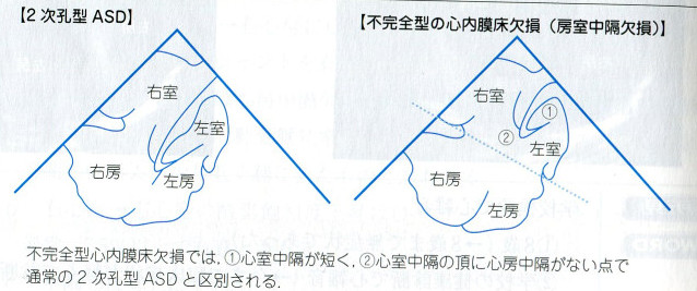 Atrial Septal Defect Asd 심방중격결손 네이버 블로그 Atrial Septal Defect Asd 심방중격결손 네이버 블로그