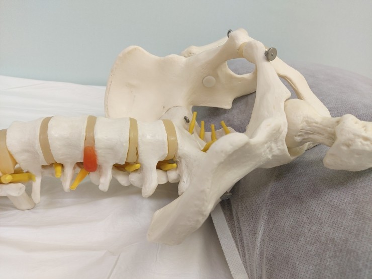 Glisthesis 똑바로 누워서 잘 수 없어요: 분리성 전방전위증(lytic listhesis)에 의한 신경구멍 협착증(foraminal ...