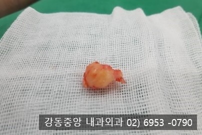 사타구니 표피낭종 산부인과 주사 VS 외과 수술 (천보성 외과) : 네이버 블로그 사타구니 표피낭종 산부인과 주사 Vs 외과 수술 (천보성 외과) : 네이버 블로그