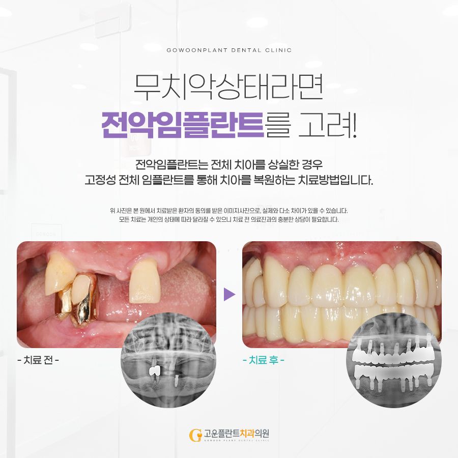 수플란트치과병원-Suplant added a new photo. - 수플란트치과병원-Suplant, image size:900x900